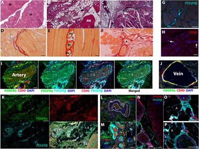 Distinct human skeletal muscle-derived CD90 progenitor subsets for myo-fibro-adipogenic disease modeling and treatment in multiplexed conditions